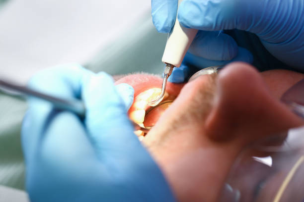 Best Emergency Dental Care for Abscessed Tooth in Belmont, PA